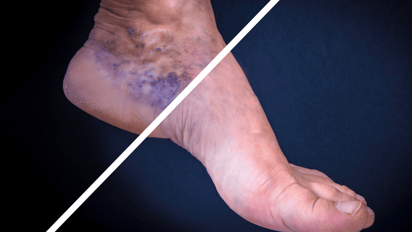 Understanding Venous Insufficiency and Varicose Veins New York
